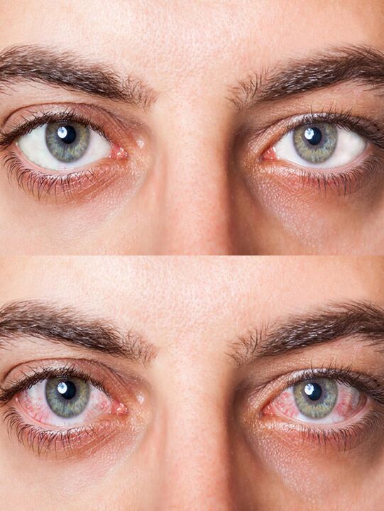 antes e despois do tratamento con gotas de Oculear